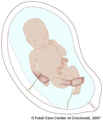 Amniotic band syndrome